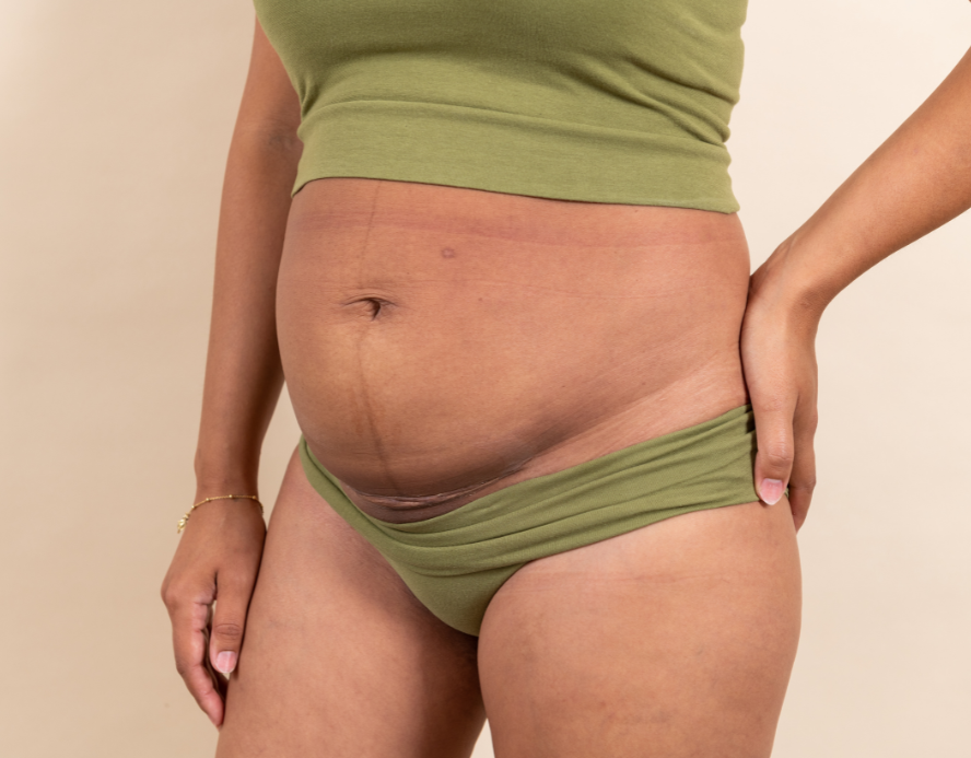 Cicatrisation après une césarienne : on vous dit tout !